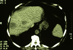 Two right sided colonic Secondaries in a young patient with a small left liver